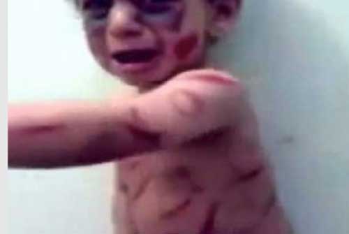 أمّ تكسر ذراعي طفلها وتحرق جسمه بالسجائر.. والسبب أكثر فظاعة!