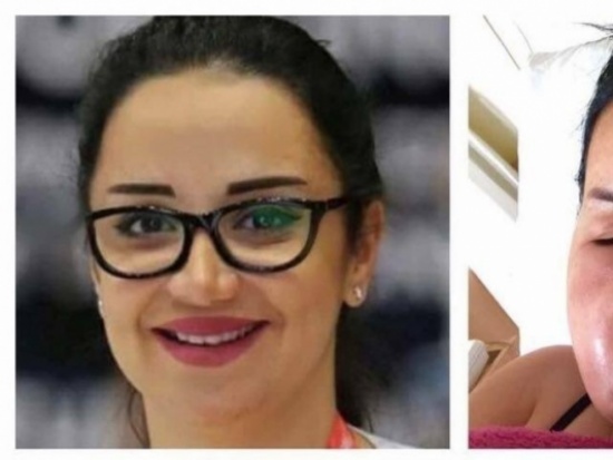 بالصور - عمليات التجميل تحصد ضحية جديدة في لبنان... لن تصدقوا ما حلّ بـ"باسمة"!