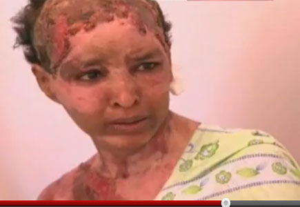 شويغا الإثيوبية تعرضت للحرق من قبل زوجة هانيبعل عارضة الأزياء اللبنانية آلين ( فيديو ) شويغا الإثيوبية تعرضت للحرق من قبل زوجة هانيبعل عارضة الأزياء اللبنانية آلين ( فيديو )