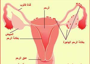 ندوة علمية بمؤتة حول امراض بطانة الرحم