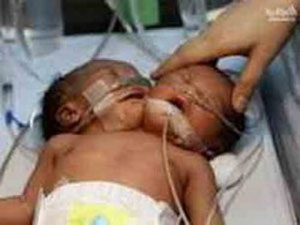ولادة طفل ميت برأسين و4 أرجل غرب الجزائر