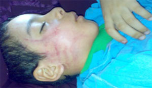 أب يتهم طبيب تخدير بصفع ابنه على وجهه حتى تورم.. لمنعه من البكاء داخل غرفة العمليات