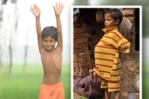 مأساة طفل هندي ولد بـ8 أطراف تنتهي بجراحة نادرة