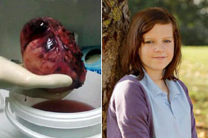 "معجزة طبية" تنقذ طفلة بريطانية من ورم بحجم كرة الركبي