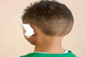 حلاق يقطع أذن طفل بسبب "عطسة"