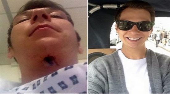 بريطاني يستخدم مبيضاً للأسنان تسبب في ثقب في فمه