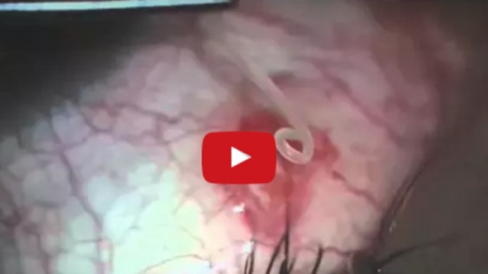 فيديو| بعد سنتين من المعاناة.. أخرج الطبيب من عينه شيئاً مثيراً للرعب!