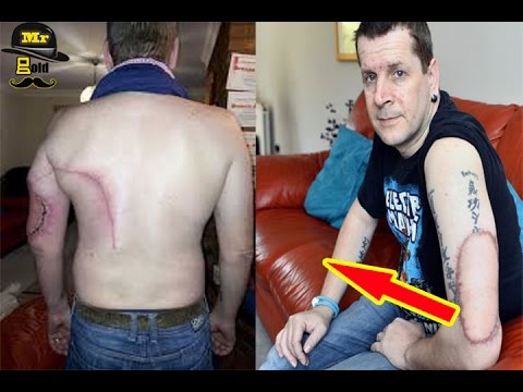 خطير جداً| اعتقد أنها عضة بعوضة.. لكن عندما ذهب للطبيب كانت الكارثة! خطير جداً| اعتقد أنها عضة بعوضة.. لكن عندما ذهب للطبيب كانت الكارثة!