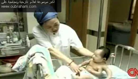 طفل صيني بثلاث ايدي