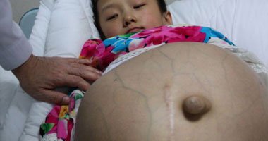 طفلة صينية تعانى من ورم يجعلها تبدو كالحوامل طفلة صينية تعانى من ورم يجعلها تبدو كالحوامل