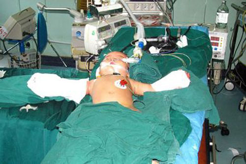 جدة صينية تقطع ذراعي حفيدتها.. وجراحة نادرة تعيد زراعتهما