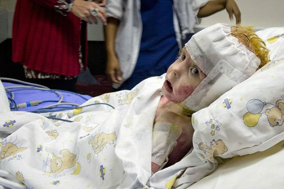 طفلة محروقة تعود إلى الحياة بترقيع 80% من جسدها