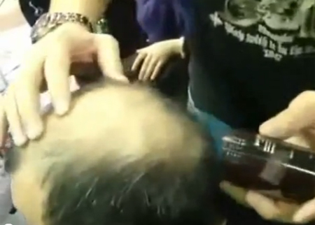 اختراع  غريب لعلاج الصلع