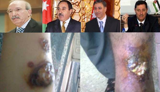 "اللاشمانيا" تشوه الاردنيين وتمتص دماءهم في الأغوار..  والحكومة " تتفرج" 