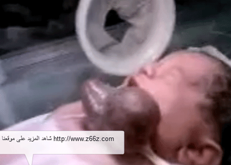 ولادة طفل قلبه خارج بطنه