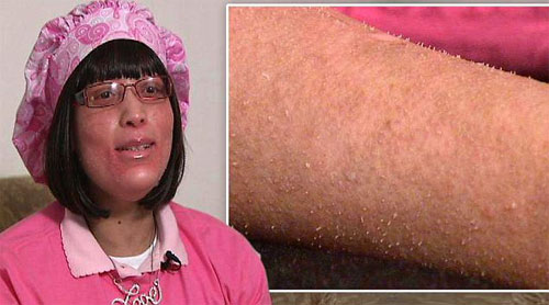 أمريكية تنمو لديها أظافر بدلا من الشعر‏!