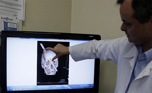 نجاة برازيلي اخترق جمجمته سيخ حديدي