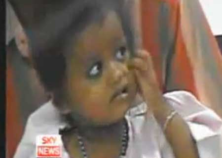 طفلة لها 4 ايادي و 4 أرجل 