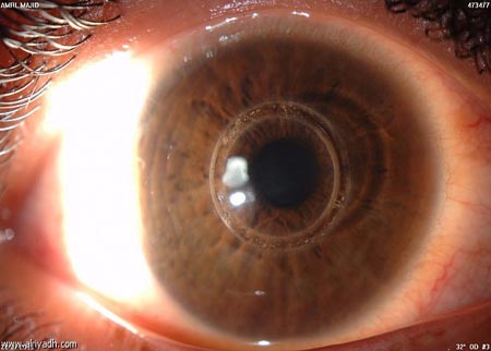 ذوو فتاة قضت بحادث سير في المشارع يتبرعون بقرنيتيها 