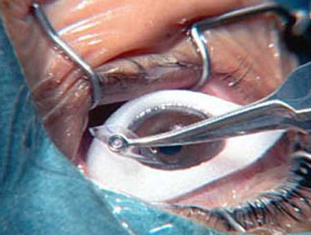 توزيع شهادات تقدير لمتبرعين بقرنيات في الاغوار الشمالية 