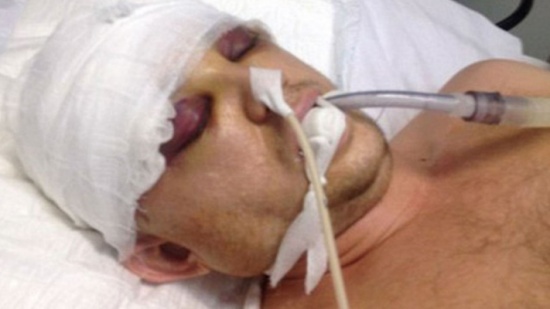 صور: شاب "تنكسر" جمجمته 3 أجزاء.. والسبب "أولوية" دخول الحمام