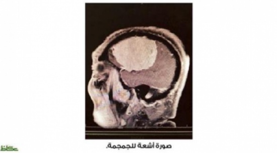 اسئصال ورم دماغي بطول 10 سنتم من جمجمة ثمانيني سعودي