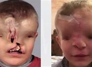 بالفيديو: إعادة بناء وجه طفل مغربي ولد بلا أنف وعينين