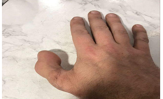 في جراحة نادرة.. رجل يستبدل إبهامه المقطوع بإصبع قدمه في جراحة نادرة.. رجل يستبدل إبهامه المقطوع بإصبع قدمه