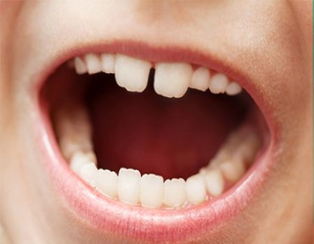 ما هي مضاعفات إهمال تسوس الأسنان اللبنية؟ ما هي مضاعفات إهمال تسوس الأسنان اللبنية؟