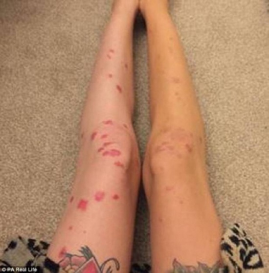 "جسد أفعى".. مرض مرعب أصابها حتّى اكتشفت الحقيقة!