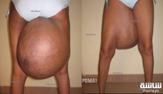 انتفخ شيئاً في فخذها أصابها بالرعب.. شاهد ماذا وجدوا داخله؟!