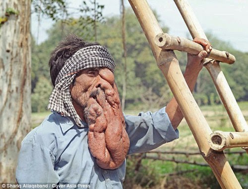 “الرجل الفيل”.. الفقر وحده جعل حالته تتفاقم !