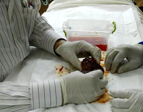 اكتشاف جنين داخل طفلة عمرها 13 يومًا في مصر