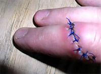 سائق تاكسي "يقضم" إصبع راكب بسبب خلاف على الأجرة