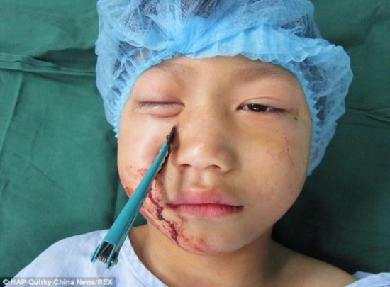 مقص يخترق وجه طفل صيني