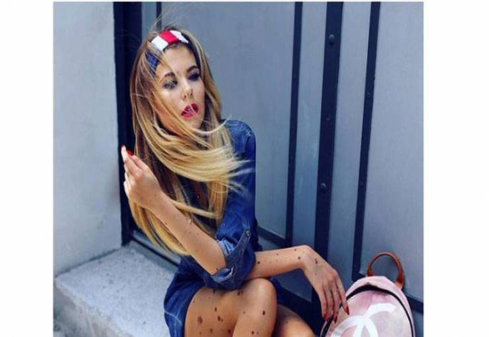 صور| "بسبب عيب خلقي" .. لقبوها بـ"كلب منقط" في الصغر!!