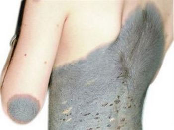 شاهد الصورة.. الطفلة الهرة تثير حيرة الأطباء  !