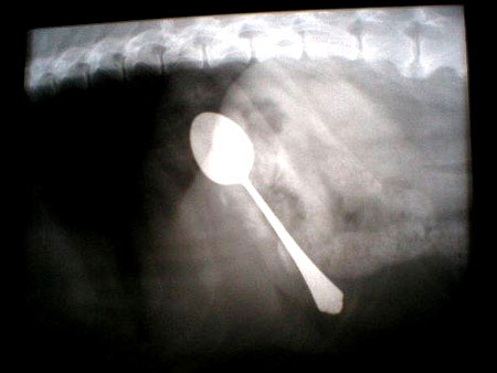 استخراج 78 ملعقة وشوكة من بطن مهووسة بابتلاع المعادن  