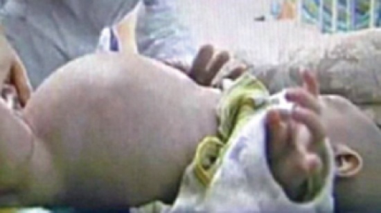 إخراج توأم من بطن طفل صيني