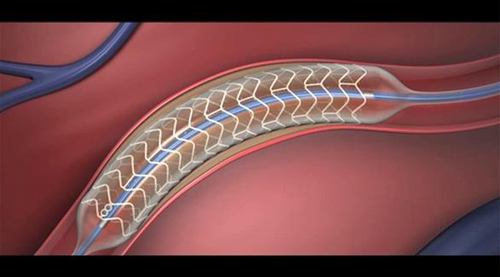 دراسة: نجاح تجربة دعامات للقلب تتحلل تلقائياً في الجسم دراسة: نجاح تجربة دعامات للقلب تتحلل تلقائياً في الجسم