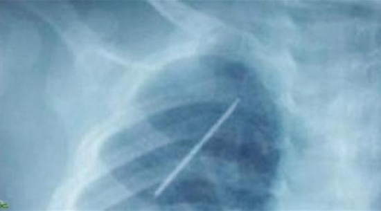 اكتشاف إبرة داخل رئة رضيع سعودي اكتشاف إبرة داخل رئة رضيع سعودي