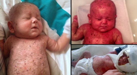 طفل يولد "محروقاً" !!