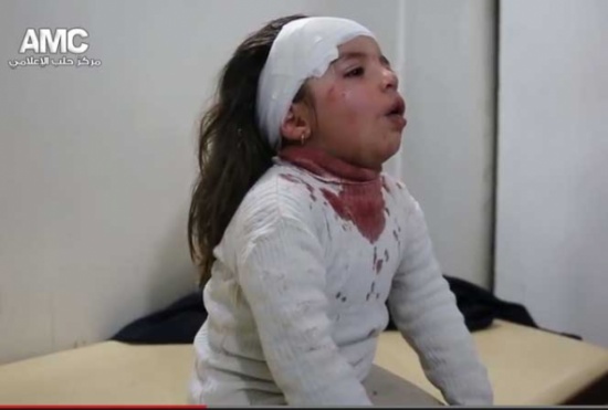 طفلة مصابة بحلب