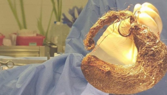 بالفيديو: استخراج شعر طفلة من أحشائها بعد أن اعتادت أكله.. والطبيب يشرح حالتها ويحذر‎