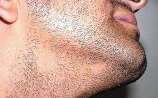 7 نصائح من أجل التخلص من فراغات الرأس و الذقن 7 نصائح من أجل التخلص من فراغات الرأس و الذقن