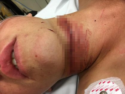 بالصور:سمّاعة “آيفون” تنحر رقبة مراهق في أستراليا