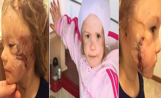 طفلة تفقد أذنها في هجوم وحشي لكلب مفترس طفلة تفقد أذنها في هجوم وحشي لكلب مفترس