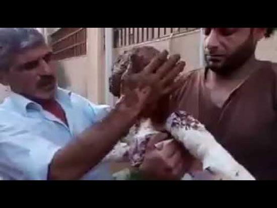 فيديو| قنابل “النابالم” تشوه جسد طفل بحي الوعر بحمص.. والأهالي يبردونه بالطين بسبب غياب الدواء