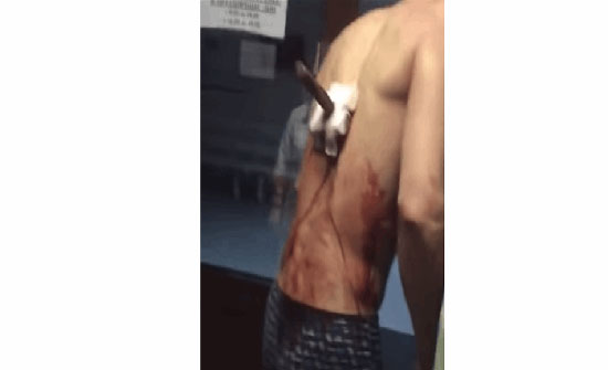 سكين مغروز بظهره لم يمنعه عن السيجارة! (فيديو)