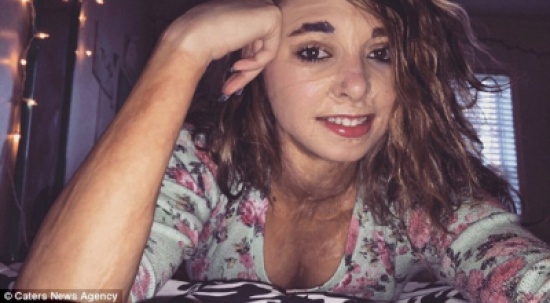 بالصور.. فتاة مصابة بحروق تتخطى تشوهات جسدها بـ«الوشم»